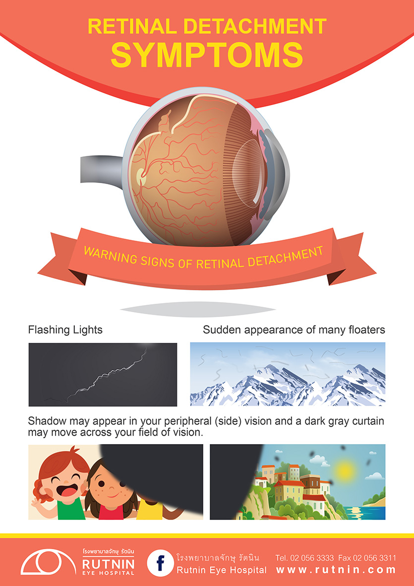 Retinal Detachment Symptoms