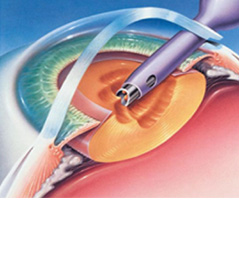 PHACO (Ultrasound Treatment of Cataracts)