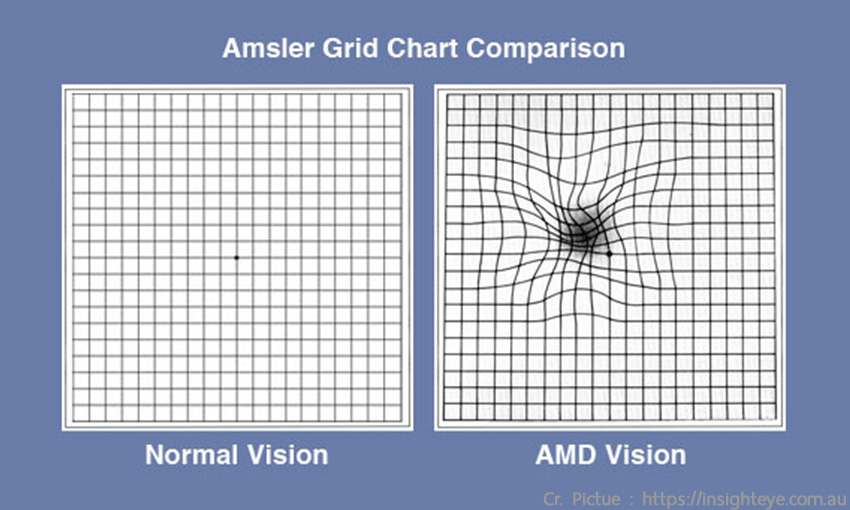 Macular Degeneration Amsler Chart.