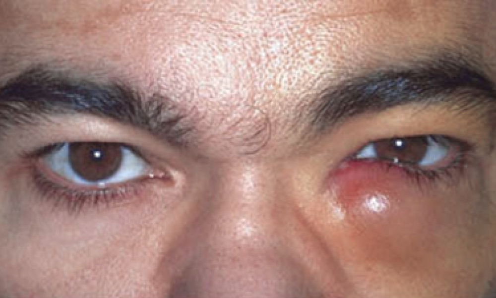 clogged lacrimal duct